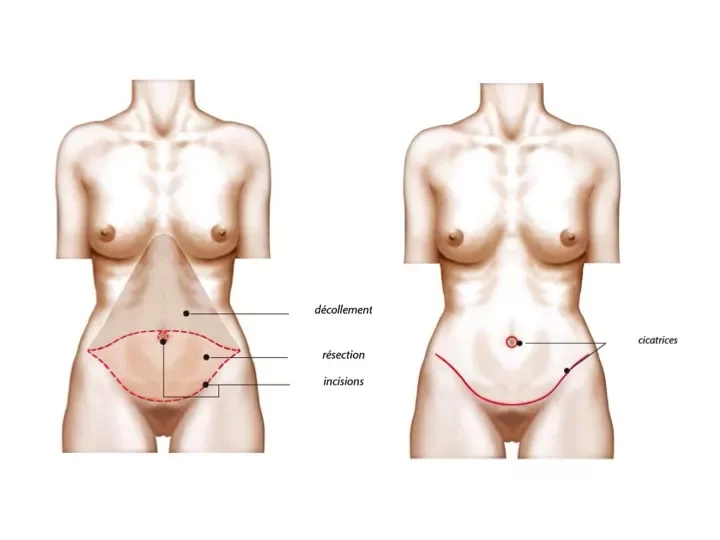 Prise en charge de l'abdominoplastie ou plastie abdominale