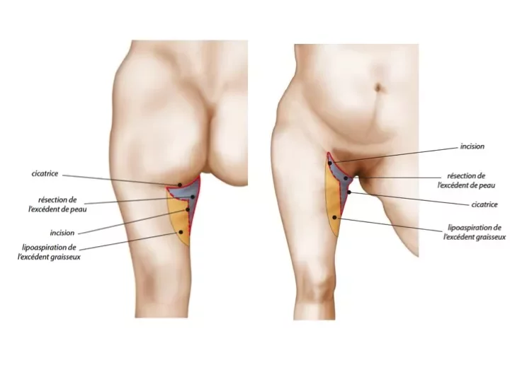 La chirurgie esthétique des cuisses : qu'est ce qu'un lifting des cuisses ?