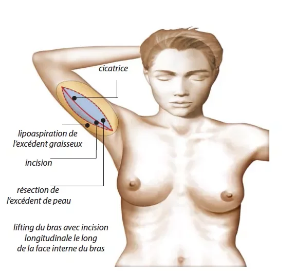 Lifting des bras : tout savoir sur la brachioplastie à l'étranger