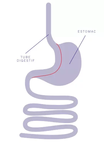 sleeve gastrique