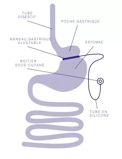 Anneau gastrique ajustable