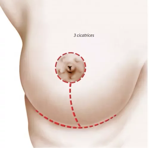 Chirurgie post amaigrissement des seins